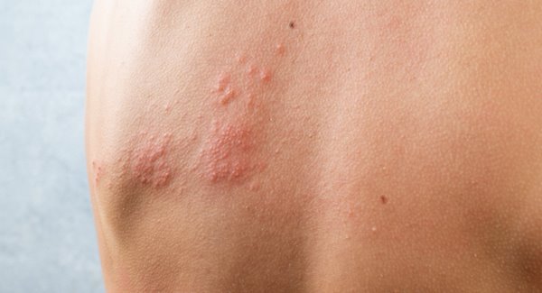 Rheumatoid Arthritis Raises Shingles Risk